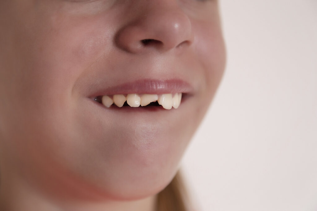 advice for when your child chips a tooth in Newcastle