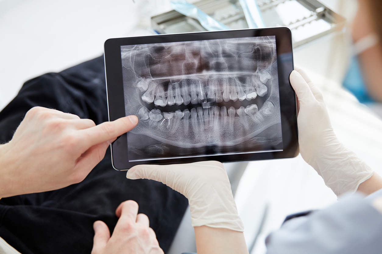 Morrin Dental professional explaining the difference between saving a tooth and tooth extraction using digital X-rays.